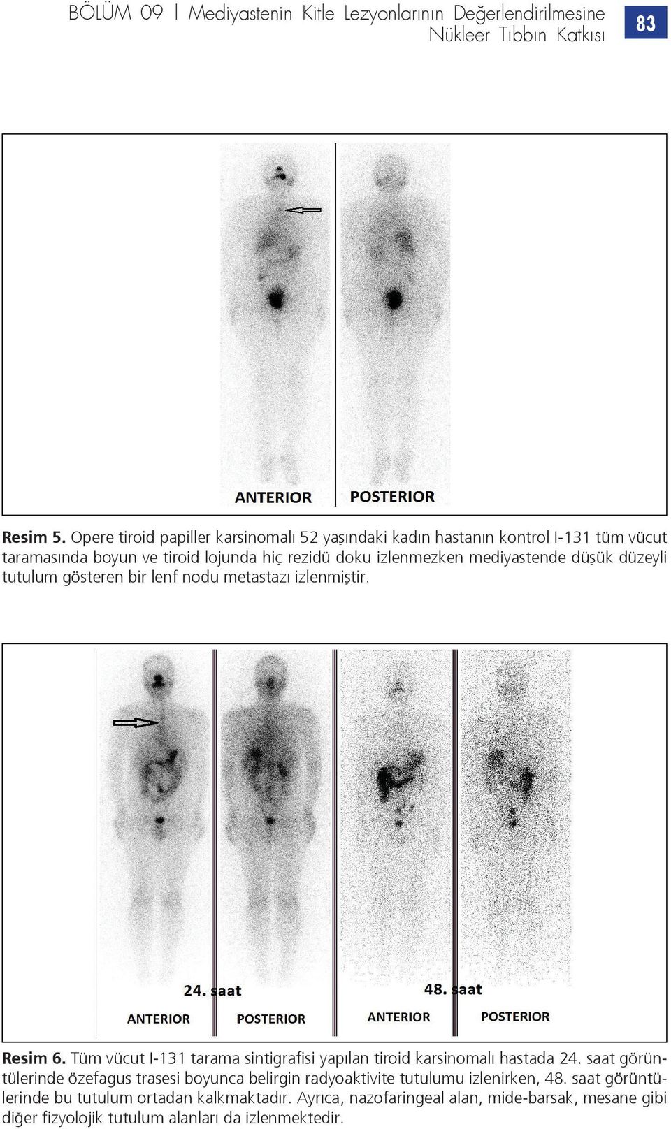 düşük düzeyli tutulum gösteren bir lenf nodu metastazı izlenmiştir. Resim 6. Tüm vücut I-131 tarama sintigrafisi yapılan tiroid karsinomalı hastada 24.
