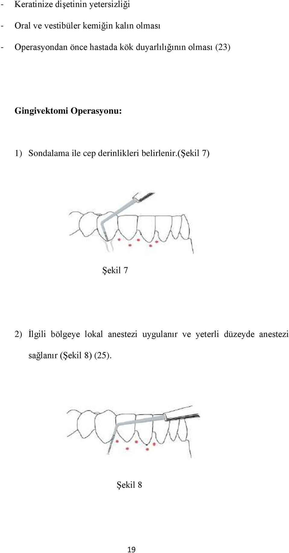 1) Sondalama ile cep derinlikleri belirlenir.