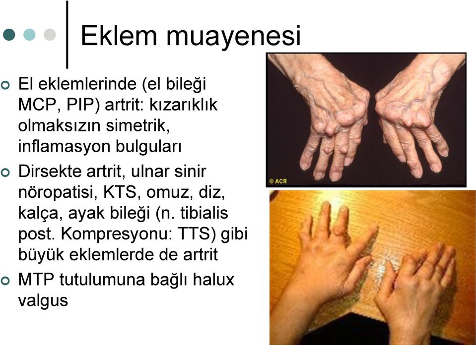 nöropatisi, KTS, omuz, diz, kalça, ayak bileği (n. tibialis post.