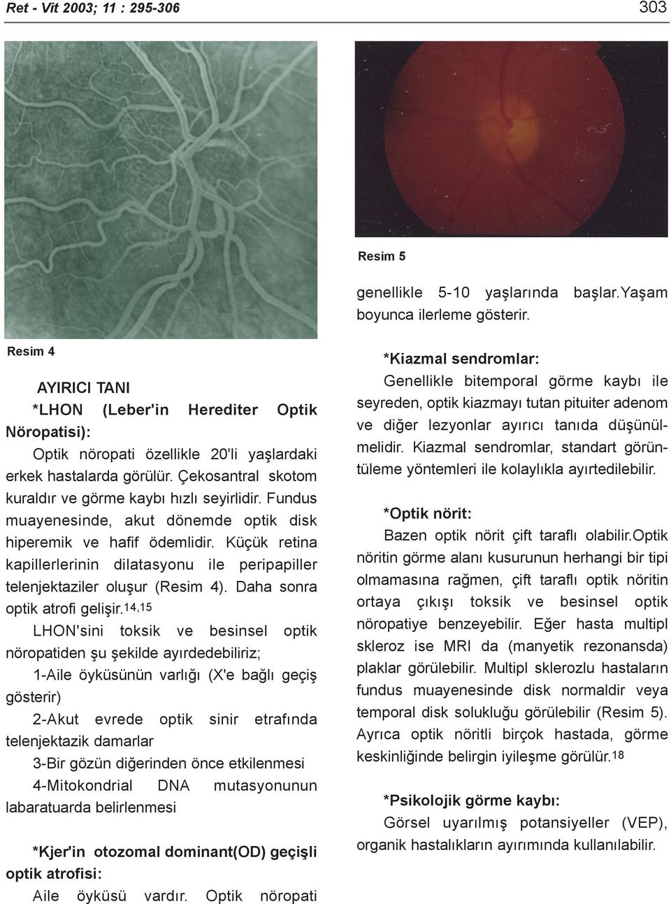Fundus muayenesinde, akut dönemde optik disk hiperemik ve hafif ödemlidir. Küçük retina kapillerlerinin dilatasyonu ile peripapiller telenjektaziler oluþur (Resim 4). Daha sonra optik atrofi geliþir.