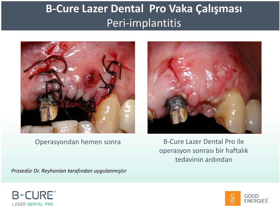 Dr. Reyhanian tarafından uygulanmıştır B-Cure Lazer