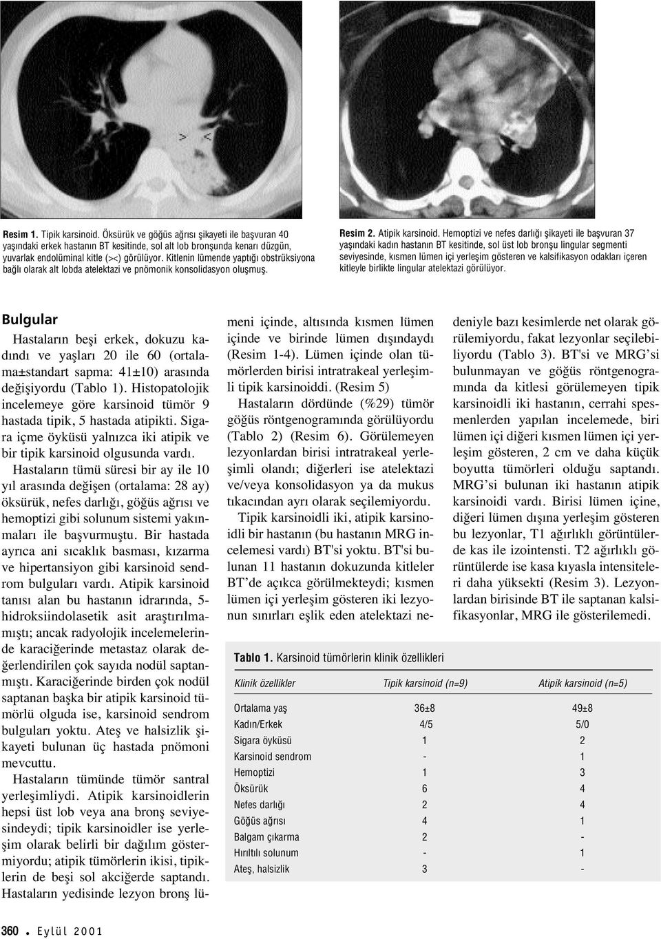 Hemoptizi ve nefes darl flikayeti ile baflvuran 37 yafl ndaki kad n hastan n BT kesitinde, sol üst lob bronflu lingular segmenti seviyesinde, k smen lümen içi yerleflim gösteren ve kalsifikasyon
