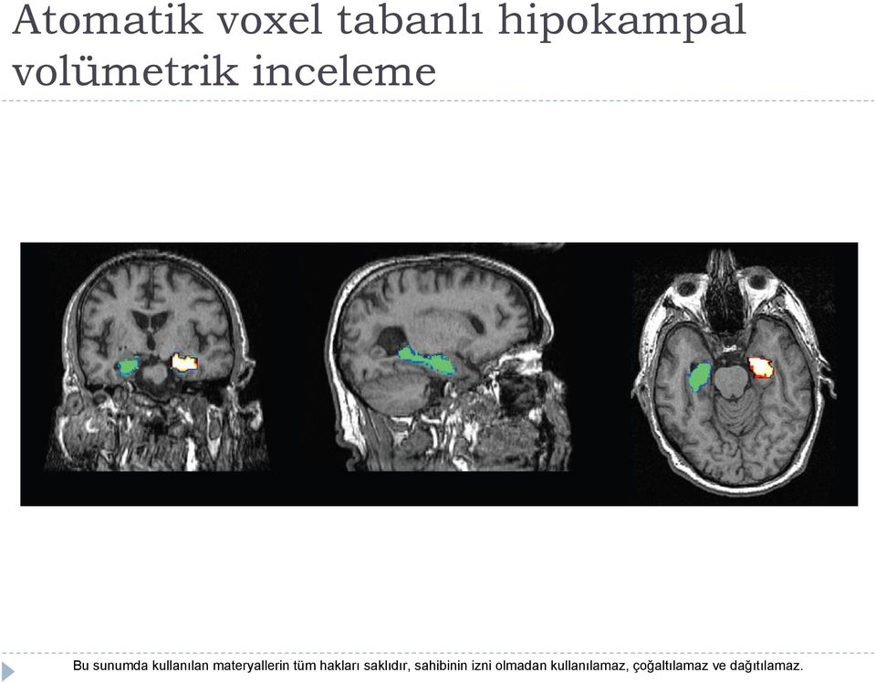 hipokampal