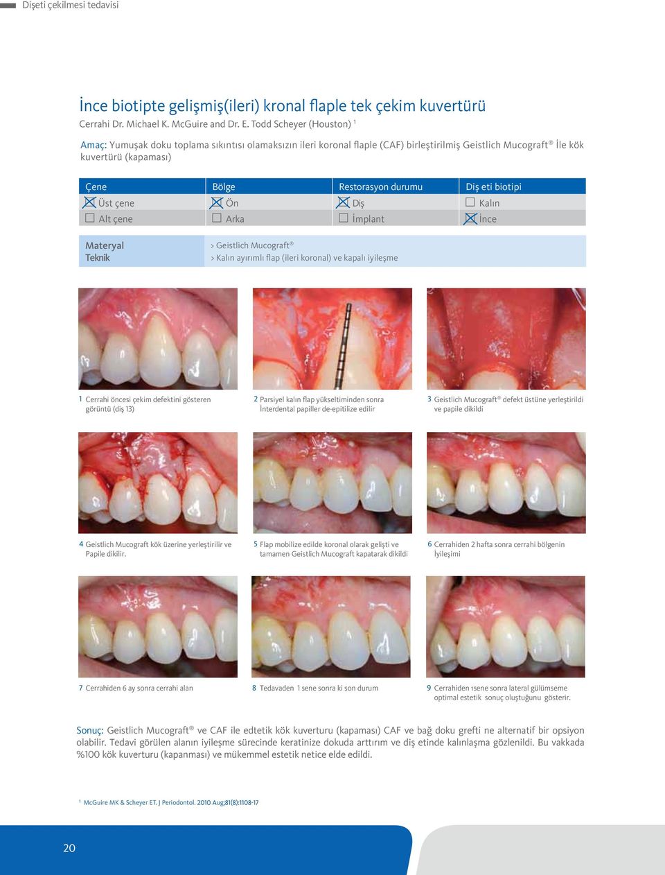 eti biotipi Üst çene Ön Diş Kalın Alt çene Arka İmplant İnce Materyal Teknik Geistlich Mucograft Kalın ayırımlı flap (ileri koronal) ve kapalı iyileşme Cerrahi öncesi çekim defektini gösteren görüntü