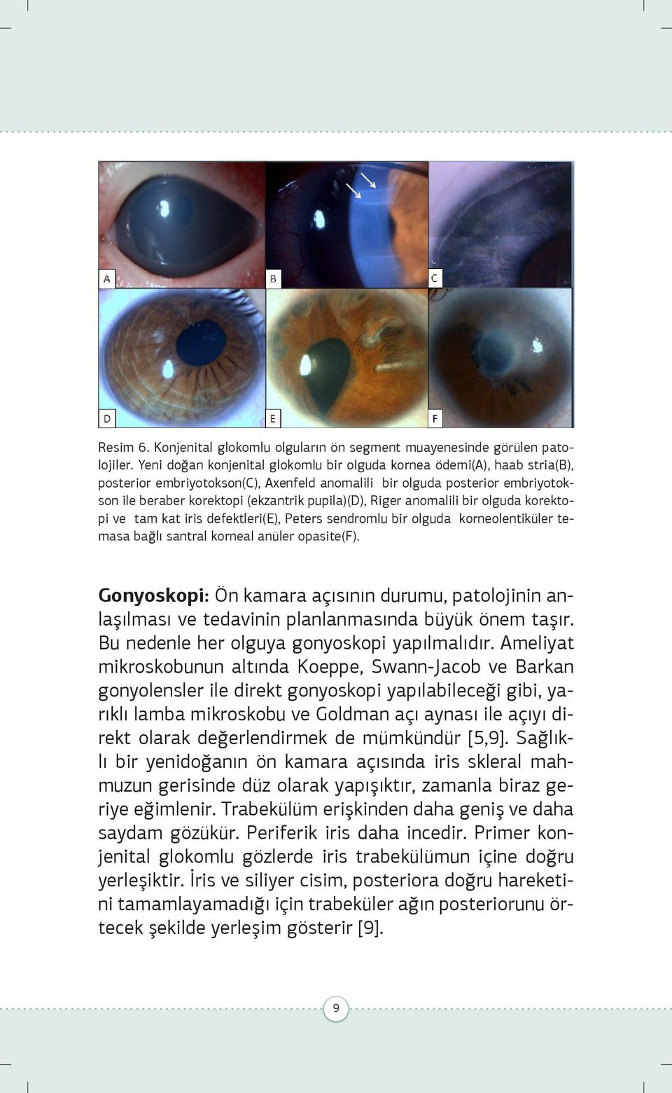pupila)(d), Riger anomalili bir olguda korektopi ve tam kat iris defektleri(e), Peters sendromlu bir olguda korneolentiküler temasa bağlı santral korneal anüler opasite(f).