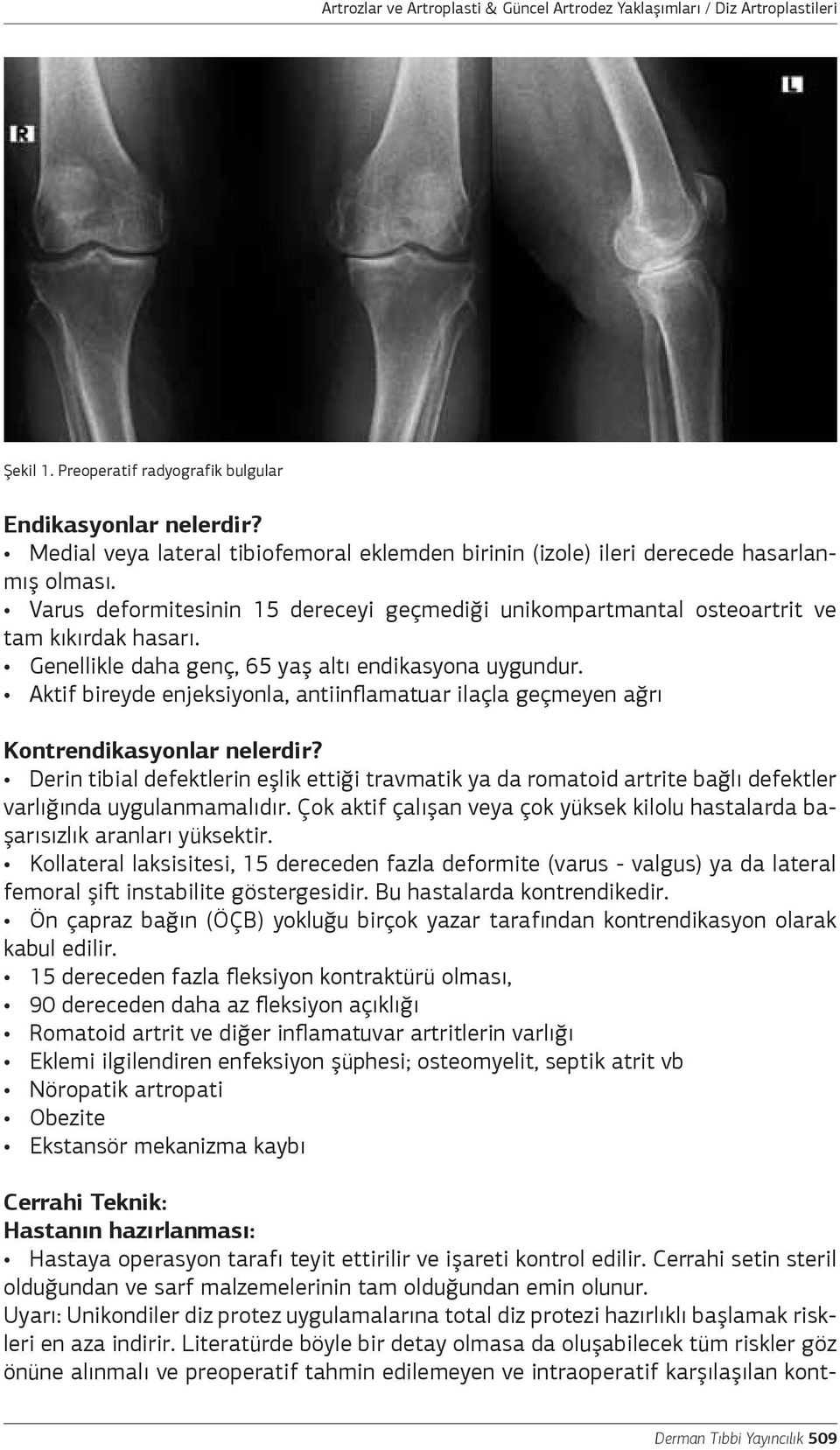 Genellikle daha genç, 65 yaş altı endikasyona uygundur. Aktif bireyde enjeksiyonla, antiinflamatuar ilaçla geçmeyen ağrı Kontrendikasyonlar nelerdir?