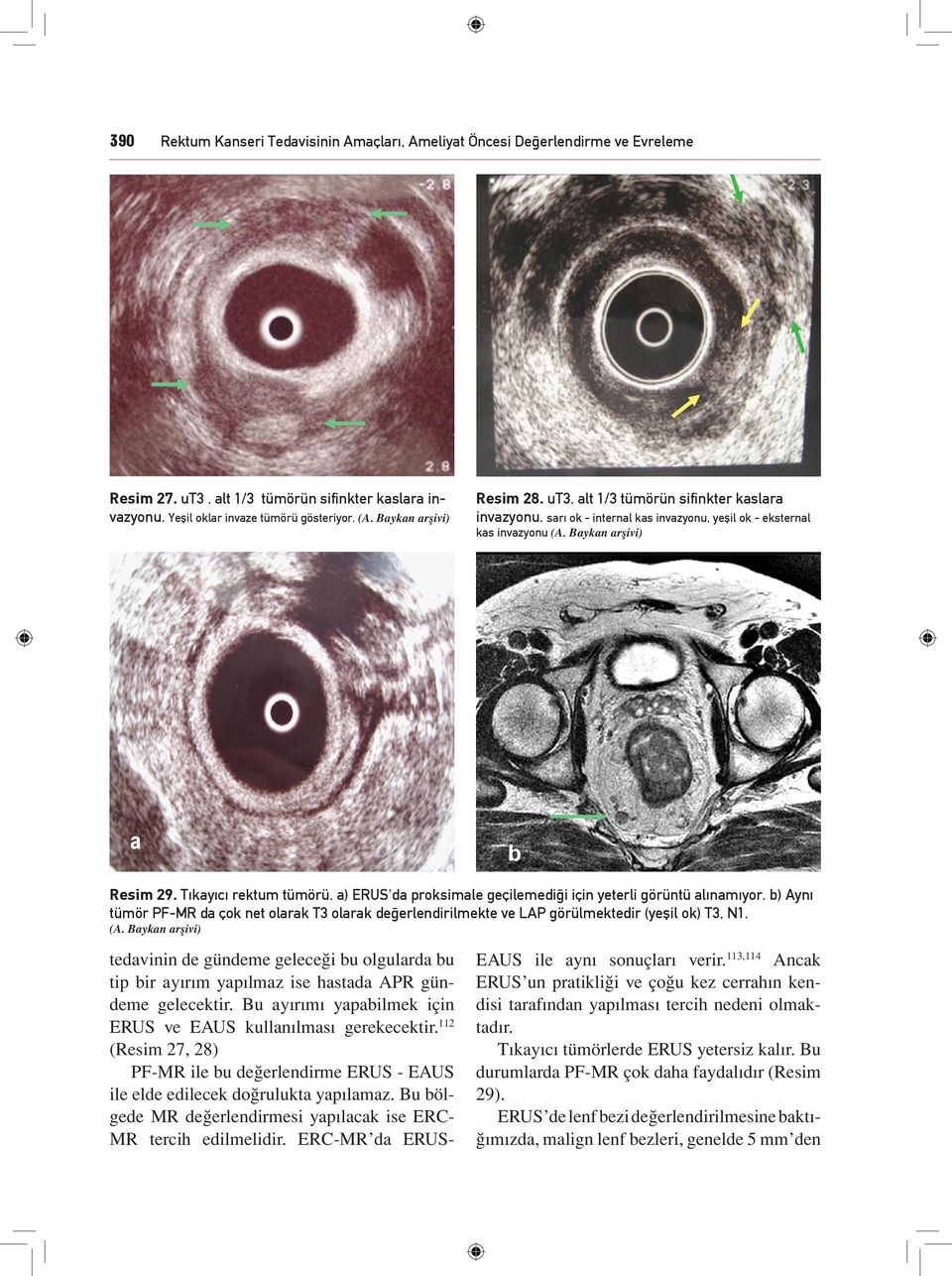 a) ERUS da proksimale geçilemediği için yeterli görüntü alınamıyor. b) Aynı tümör PF-MR da çok net olarak T3 olarak değerlendirilmekte ve LAP görülmektedir (yeşil ok) T3, N1. (A.