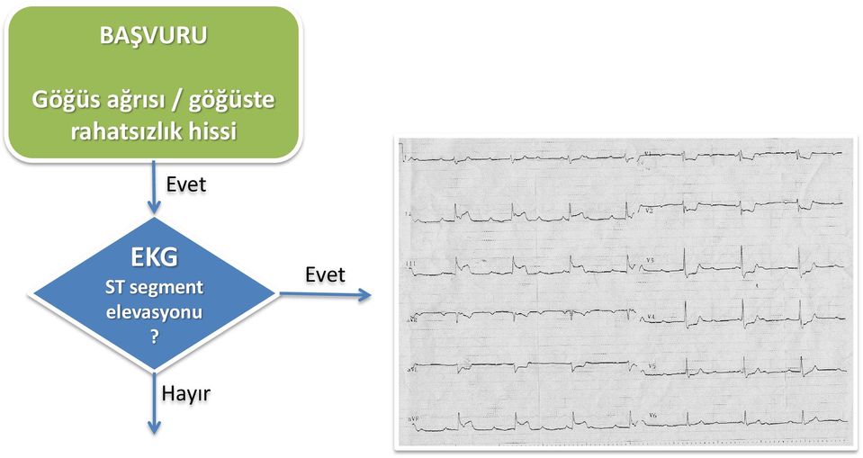 hissi Evet EKG ST