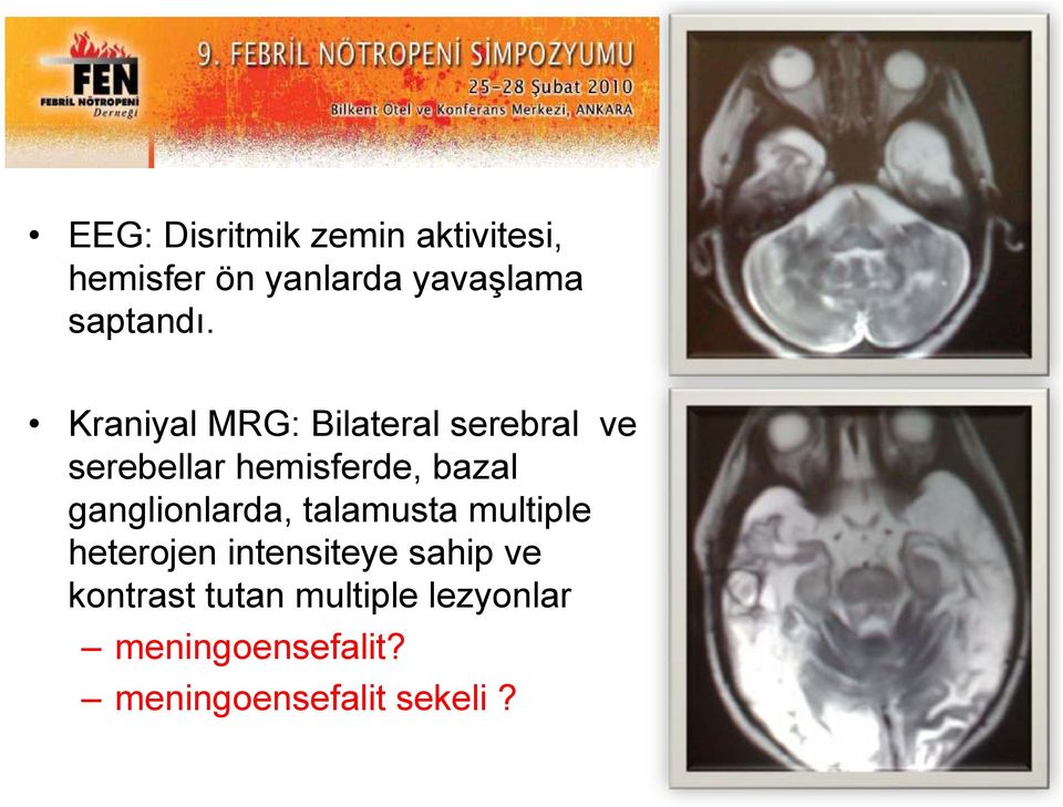 Kraniyal MRG: Bilateral serebral ve serebellar hemisferde, bazal