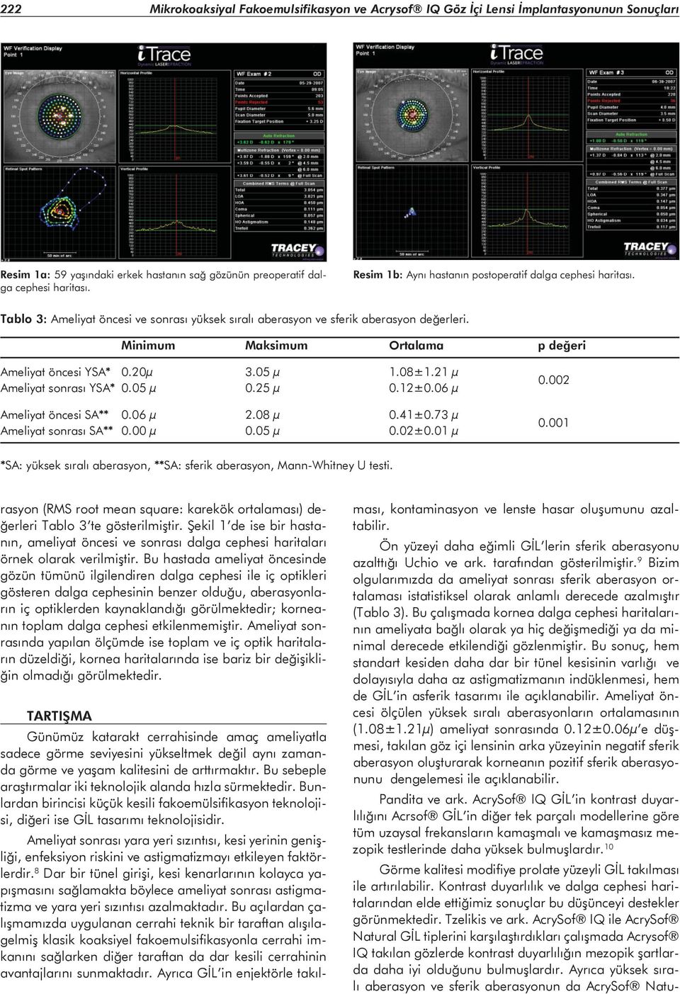 Minimum Maksimum Ortalama p değeri Ameliyat öncesi YSA* 0.20μ 3.05 μ 1.08±1.21 μ Ameliyat sonrası YSA* 0.05 μ 0.25 μ 0.12±0.06 μ Ameliyat öncesi SA** 0.06 μ 2.08 μ 0.41±0.73 μ Ameliyat sonrası SA** 0.