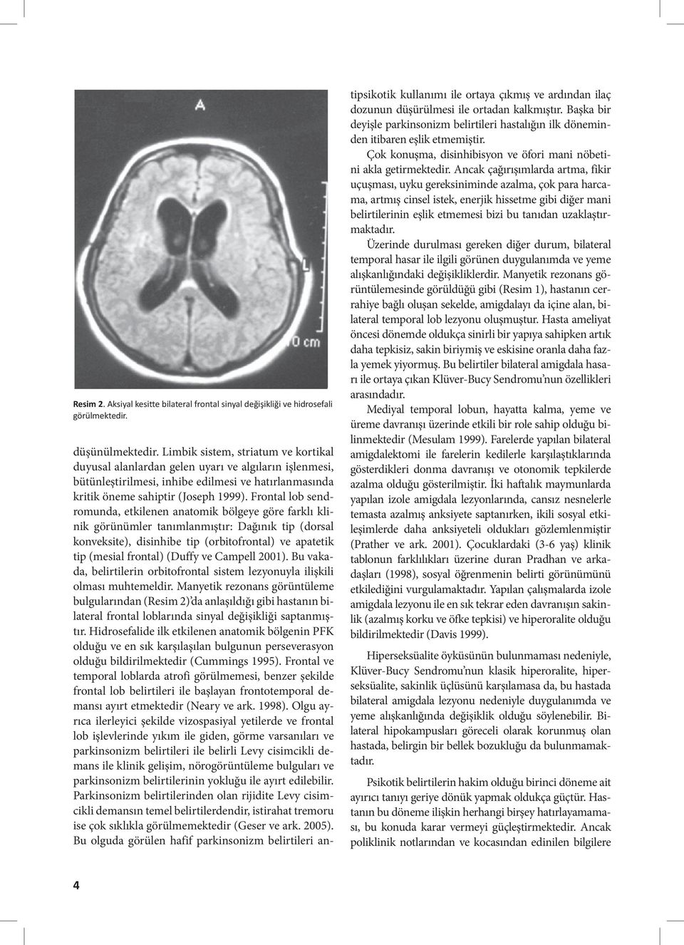 Frontal lob sendromunda, etkilenen anatomik bölgeye göre farklı klinik görünümler tanımlanmıştır: Dağınık tip (dorsal konveksite), disinhibe tip (orbitofrontal) ve apatetik tip (mesial frontal)