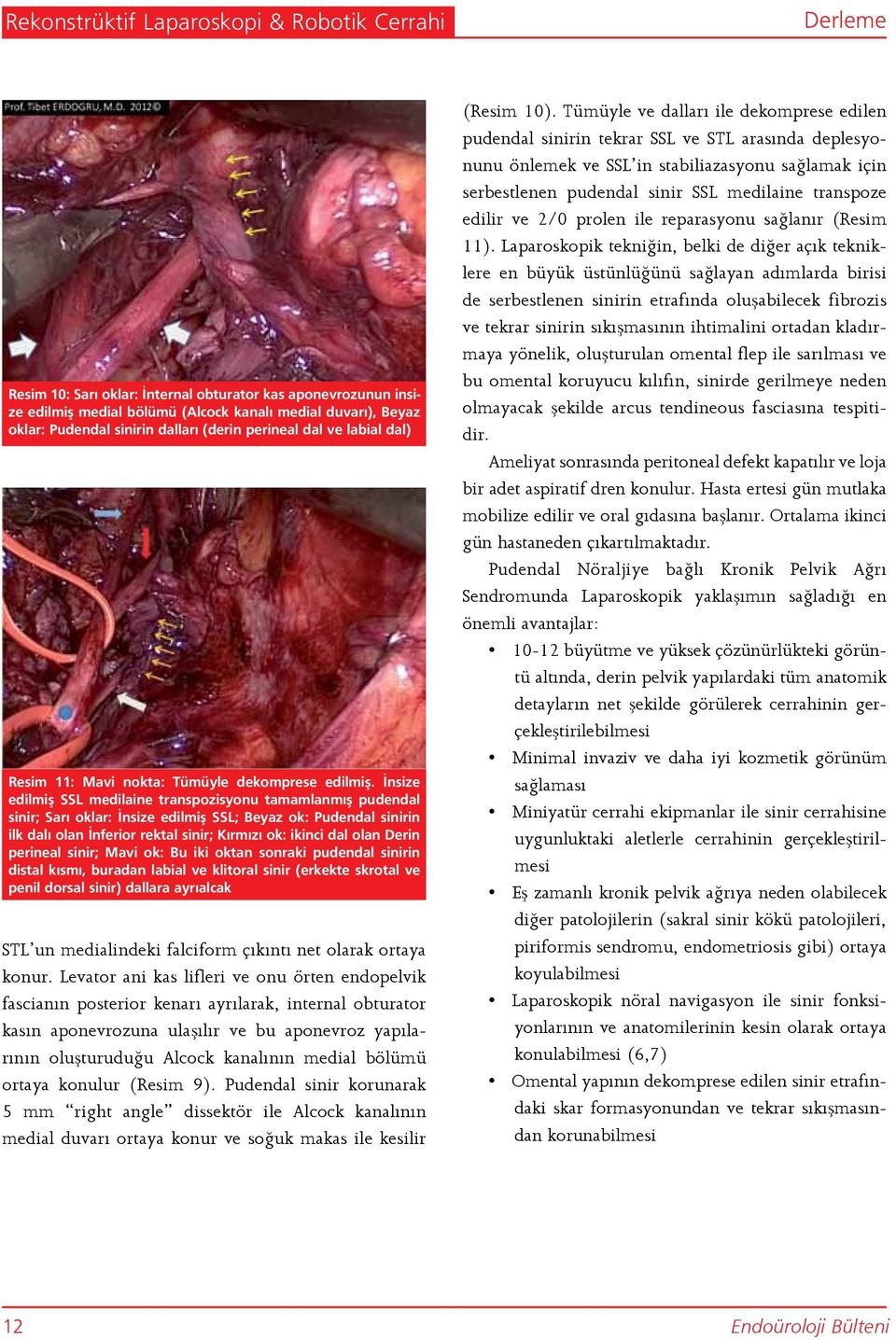 İnsize edilmiş SSL medilaine transpozisyonu tamamlanmış pudendal sinir; Sarı oklar: İnsize edilmiş SSL; Beyaz ok: Pudendal sinirin ilk dalı olan İnferior rektal sinir; Kırmızı ok: ikinci dal olan