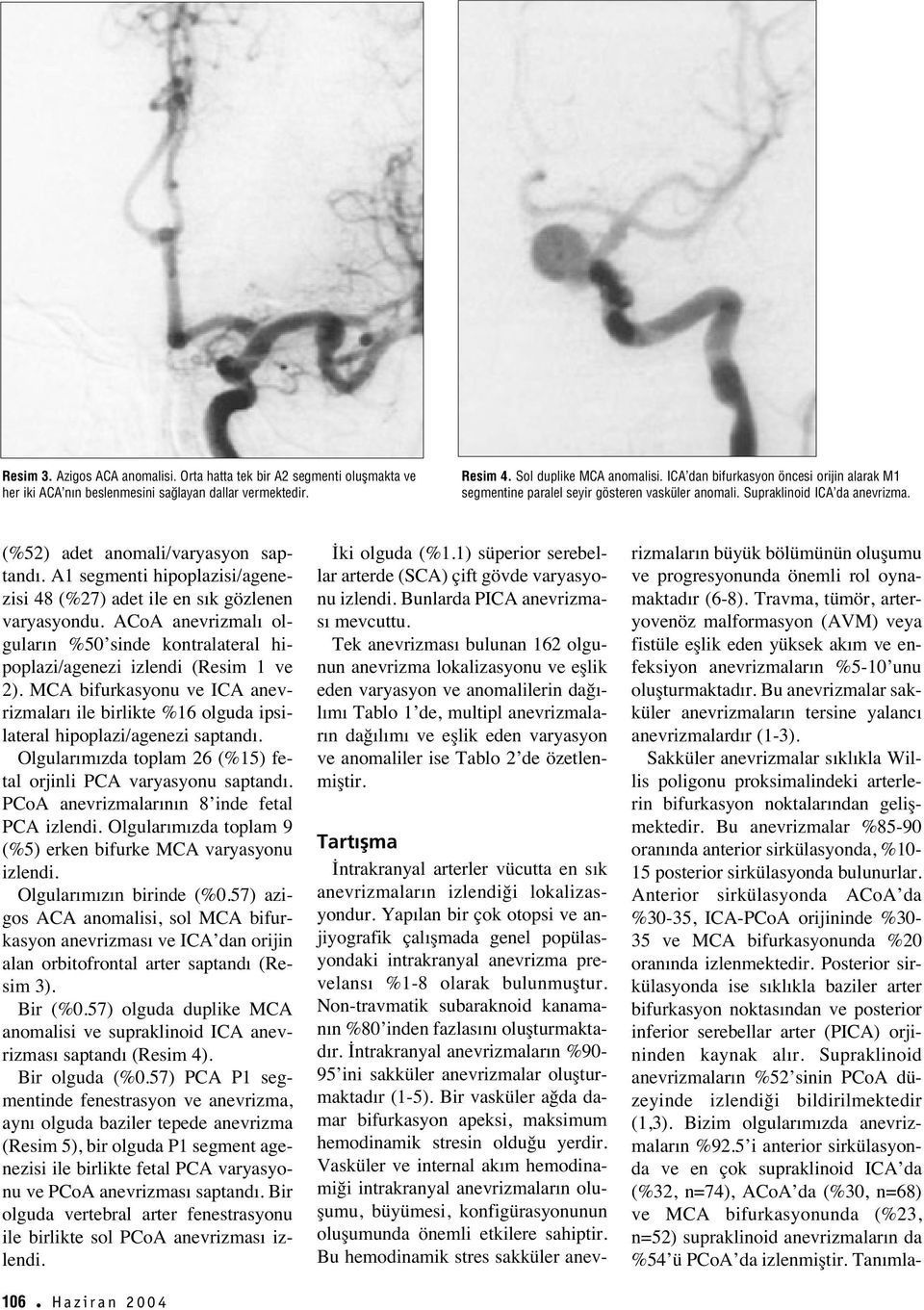 A segmenti hipoplazisi/agenezisi 48 (%) adet ile en s k gözlenen varyasyondu. ACoA anevrizmal olgular n %0 sinde kontralateral hipoplazi/agenezi izlendi (Resim ve ).