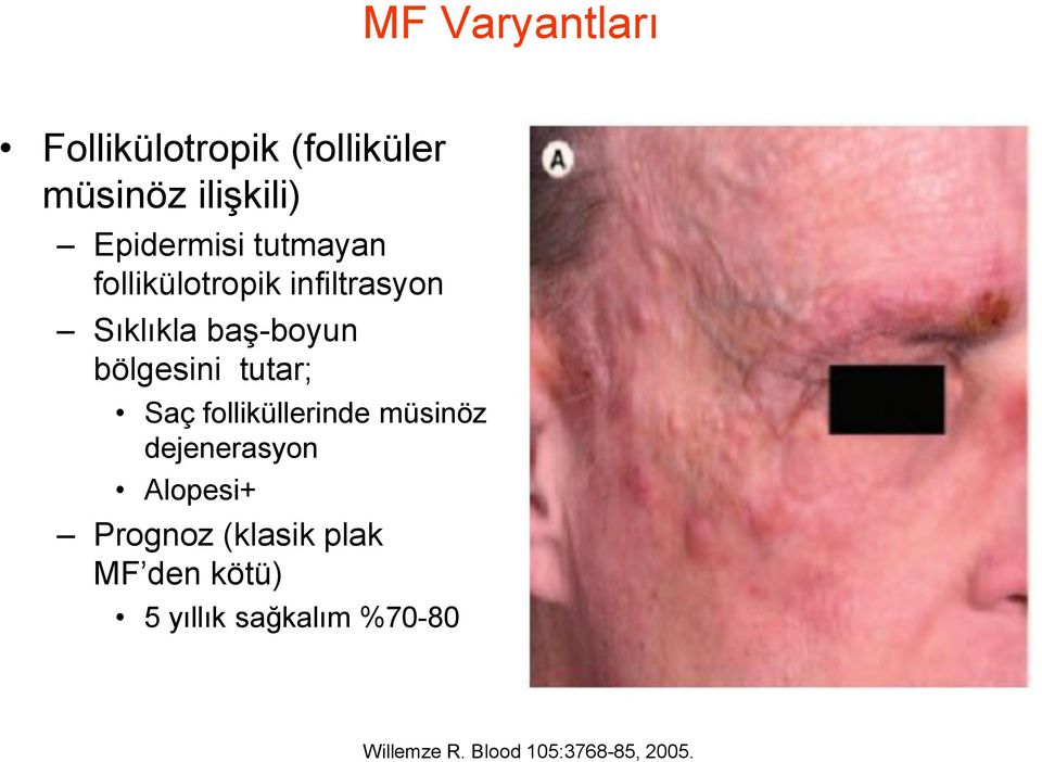 tutar; Saç folliküllerinde müsinöz dejenerasyon Alopesi+ Prognoz (klasik