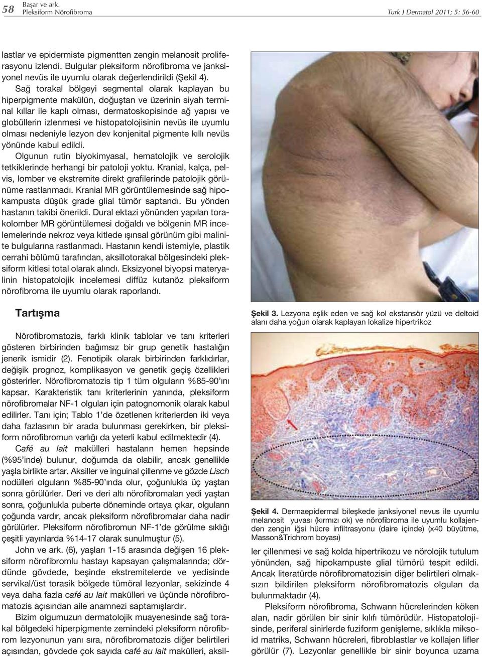 Sağ torakal bölgeyi segmental olarak kaplayan bu hiperpigmente makülün, doğuştan ve üzerinin siyah terminal kıllar ile kaplı olması, dermatoskopisinde ağ yapısı ve globüllerin izlenmesi ve