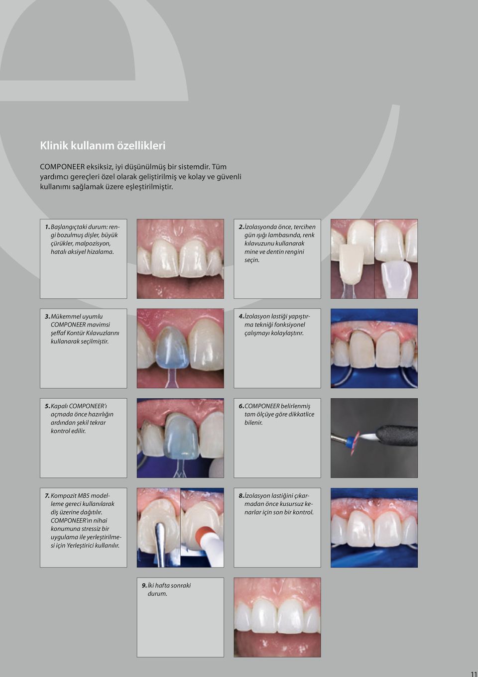 İzolasyonda önce, tercihen gün ışığı lambasında, renk kılavuzunu kullanarak mine ve dentin rengini seçin. 3. Mükemmel uyumlu COMPONEER mavimsi şeffaf Kontür Kılavuzlarını kullanarak seçilmiştir. 4.