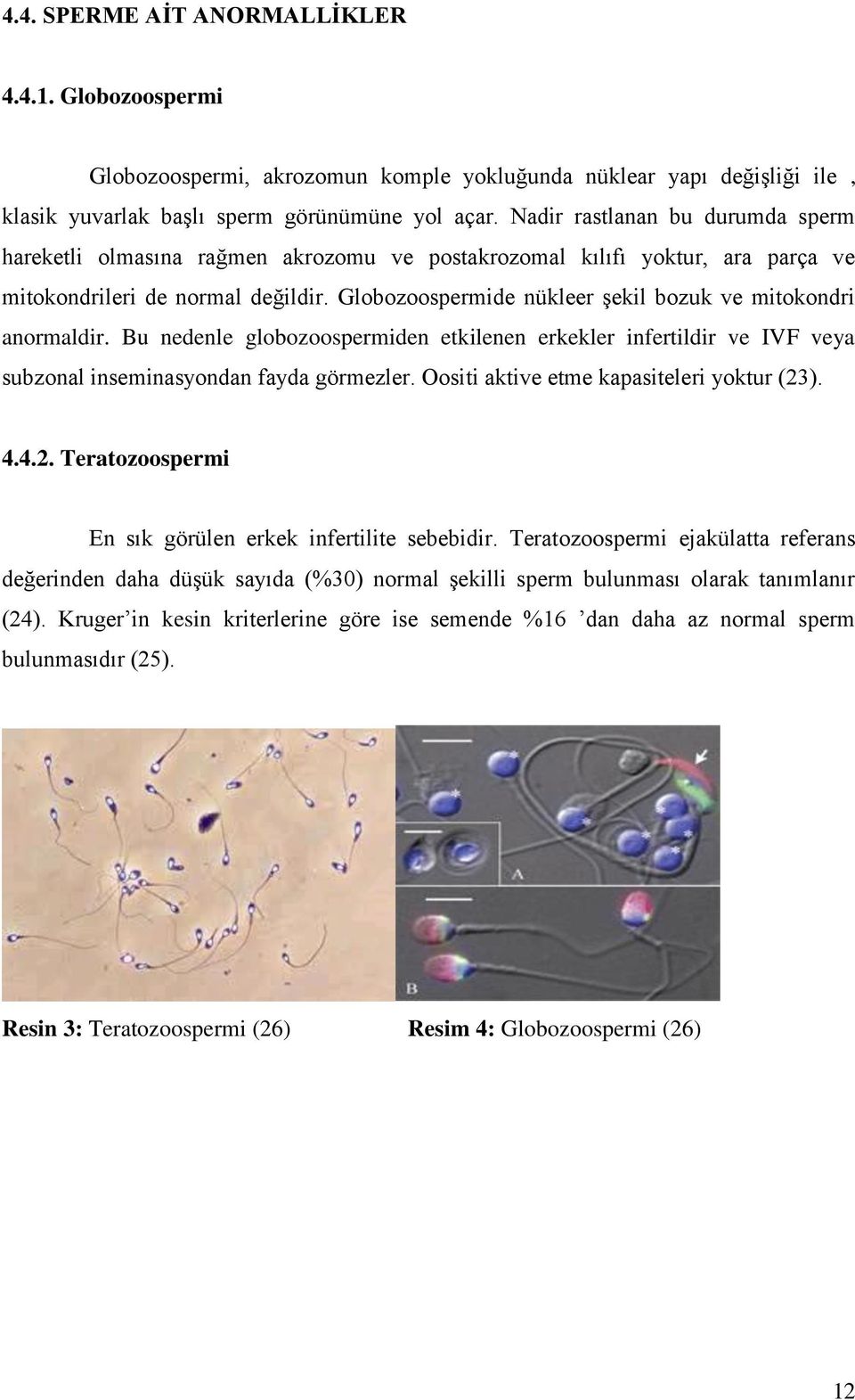 Globozoospermide nükleer Ģekil bozuk ve mitokondri anormaldir. Bu nedenle globozoospermiden etkilenen erkekler infertildir ve IVF veya subzonal inseminasyondan fayda görmezler.