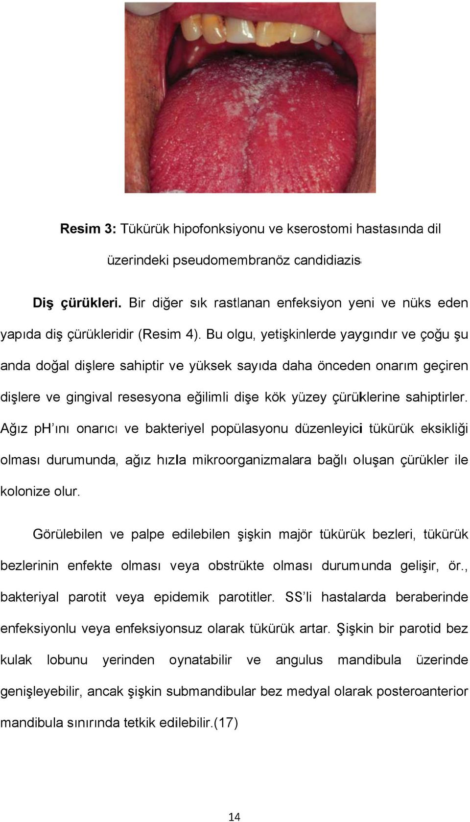 Bu olgu, yetişkinlerde yaygındır ve çoğu şu anda doğal dişlere sahiptir vee yüksek sayıda daha önceden onarım geçiren dişlere ve gingival resesyonaa eğilimli dişe kök yüzey çürüklerine sahiptirler.