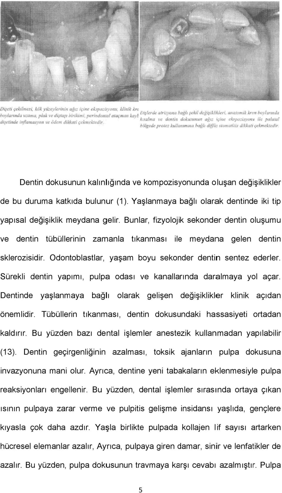 Odontoblastlar, yaşam boyu sekonder dentinn sentez ederler. Sürekli dentin yapımı, pulpaa odası ve kanallarında daralmaya yol açar.