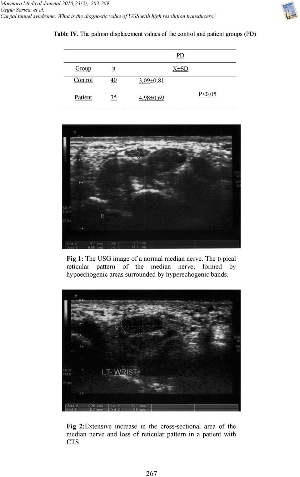 The palmar displacement values of the control and patient groups (PD) PD Group n X±SD Control 40 3,09±0,81 Patient 35 4,98±0,69 P<0.