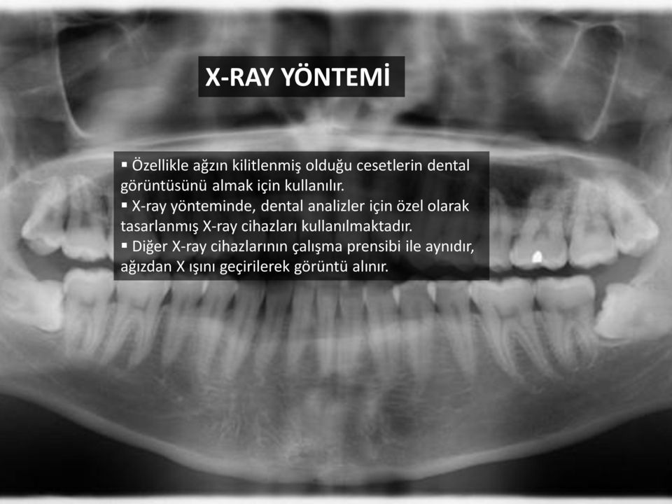 X-ray yönteminde, dental analizler için özel olarak tasarlanmış X-ray