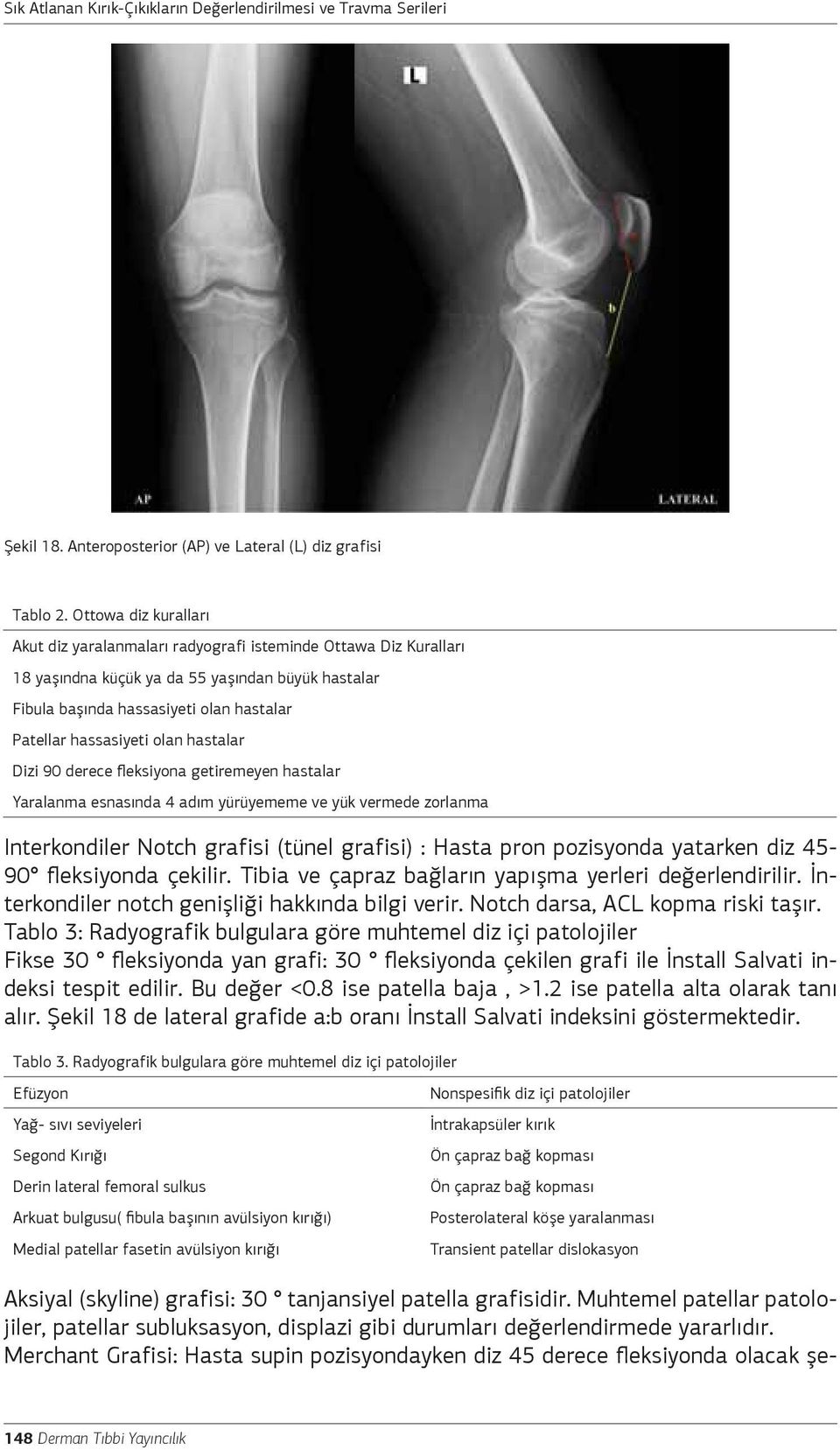 olan hastalar Dizi 90 derece fleksiyona getiremeyen hastalar Yaralanma esnasında 4 adım yürüyememe ve yük vermede zorlanma Interkondiler Notch grafisi (tünel grafisi) : Hasta pron pozisyonda yatarken