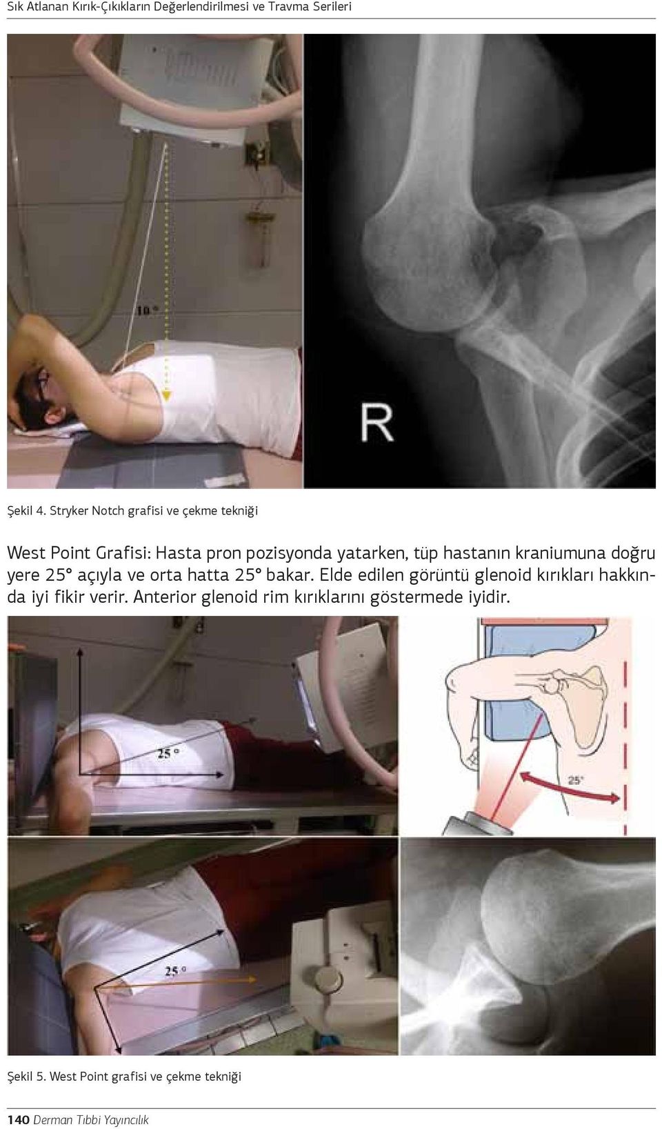 Stryker Notch grafisi ve çekme tekniği West Point Grafisi: Hasta pron pozisyonda yatarken, tüp hastanın kraniumuna doğru yere 25