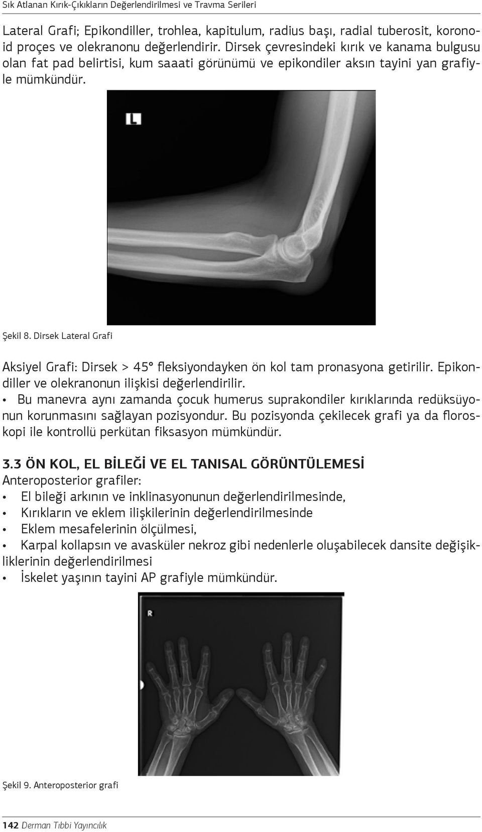 Dirsek çevresindeki kırık ve kanama bulgusu olan fat pad belirtisi, kum saaati görünümü ve epikondiler aksın tayini yan grafiyle mümkündür. Şekil 8.