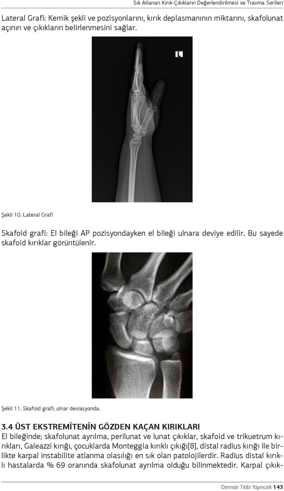 4 ÜST EKSTREMİTENİN GÖZDEN KAÇAN KIRIKLARI El bileğinde; skafolunat ayrılma, perilunat ve lunat çıkıklar, skafoid ve trikuetrum kırıkları, Galeazzi kırığı, çocuklarda Monteggia kırıklı çıkığı[8],