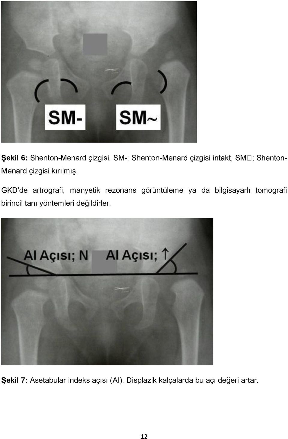 GKD de artrografi, manyetik rezonans görüntüleme ya da bilgisayarlı