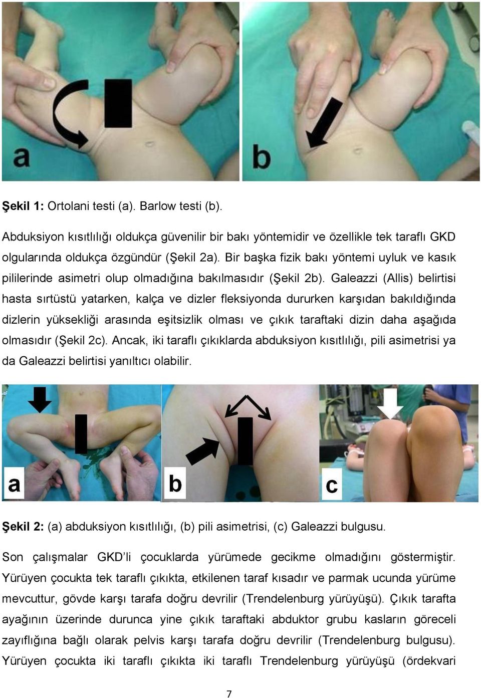 Galeazzi (Allis) belirtisi hasta sırtüstü yatarken, kalça ve dizler fleksiyonda dururken karşıdan bakıldığında dizlerin yüksekliği arasında eşitsizlik olması ve çıkık taraftaki dizin daha aşağıda