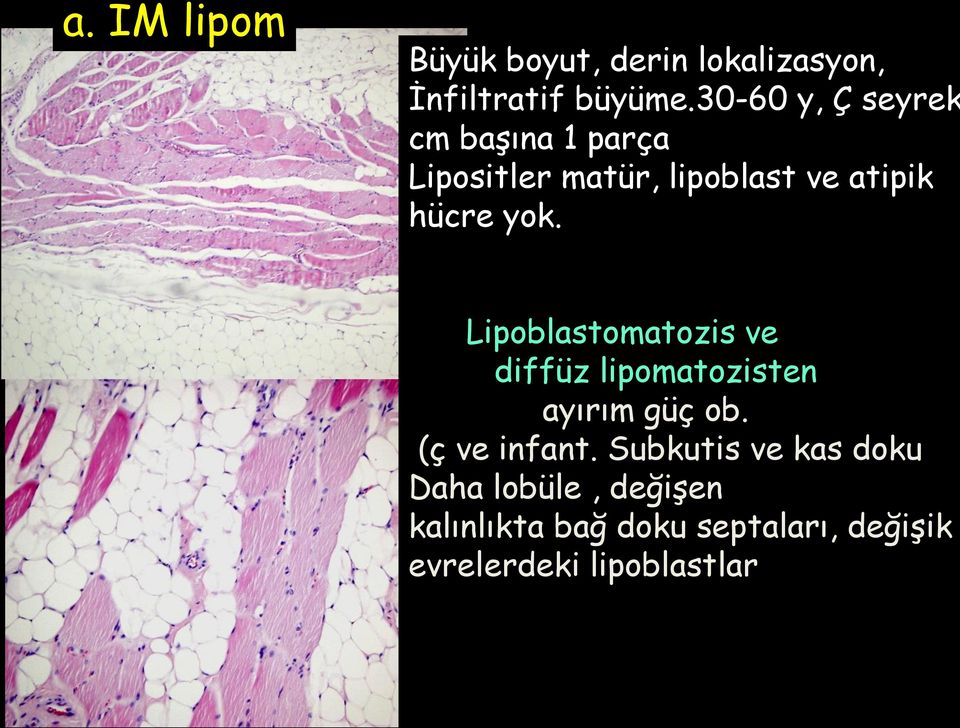 yok. Lipoblastomatozis ve diffüz lipomatozisten ayırım güç ob. (ç ve infant.