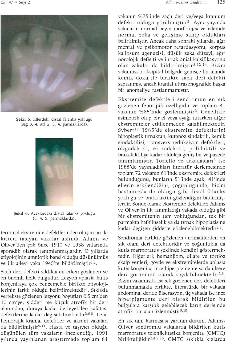 terminal ekstremite defektlerinden oluþan bu iki kriteri taþýyan vakalar aslýnda Adams ve Oliver den çok önce 1910 ve 1938 yýllarýnda sporadik olarak tanýmlanmýþlardýr.