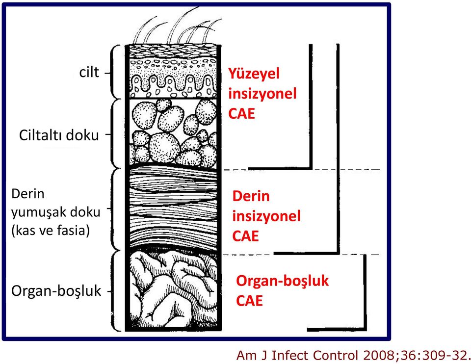 fasia) Organ-boşluk Derin insizyonel CAE