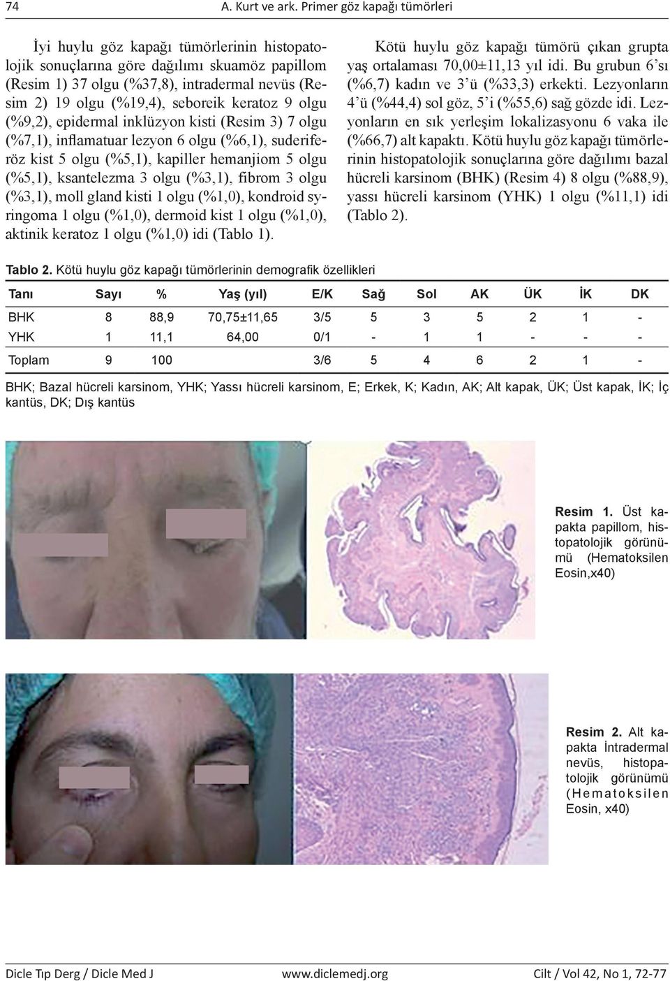 seboreik keratoz 9 olgu (%9,2), epidermal inklüzyon kisti (Resim 3) 7 olgu (%7,1), inflamatuar lezyon 6 olgu (%6,1), suderiferöz kist 5 olgu (%5,1), kapiller hemanjiom 5 olgu (%5,1), ksantelezma 3