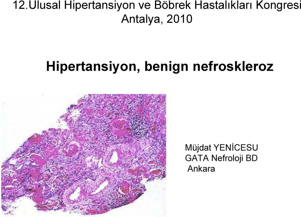 Hipertansiyon, benign nefroskleroz