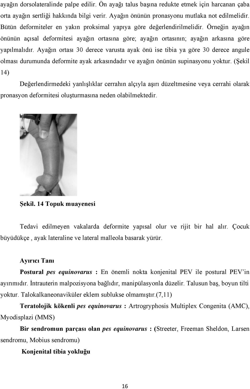 Ayağın ortası 30 derece varusta ayak önü ise tibia ya göre 30 derece angule olması durumunda deformite ayak arkasındadır ve ayağın önünün supinasyonu yoktur.