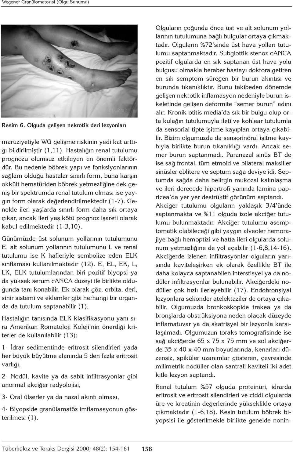 Bu nedenle böbrek yapı ve fonksiyonlarının sağlam olduğu hastalar sınırlı form, buna karşın okkült hematüriden böbrek yetmezliğine dek geniş bir spektrumda renal tutulum olması ise yaygın form olarak