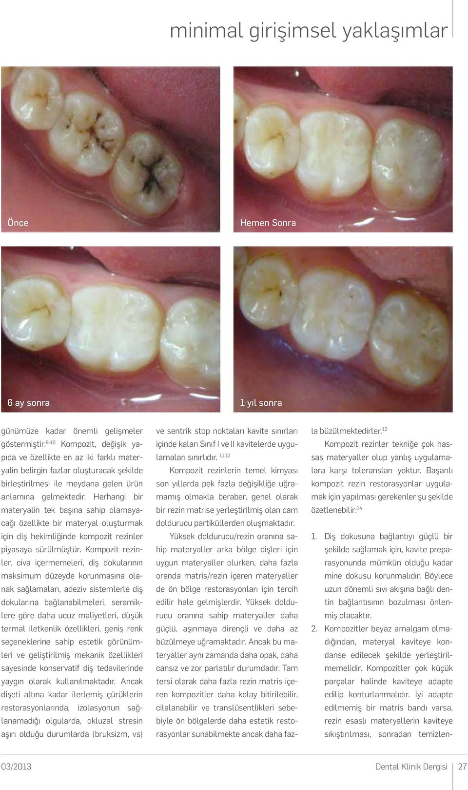 Herhangi bir materyalin tek başına sahip olamayacağı özellikte bir materyal oluşturmak için diş hekimliğinde kompozit rezinler piyasaya sürülmüştür.