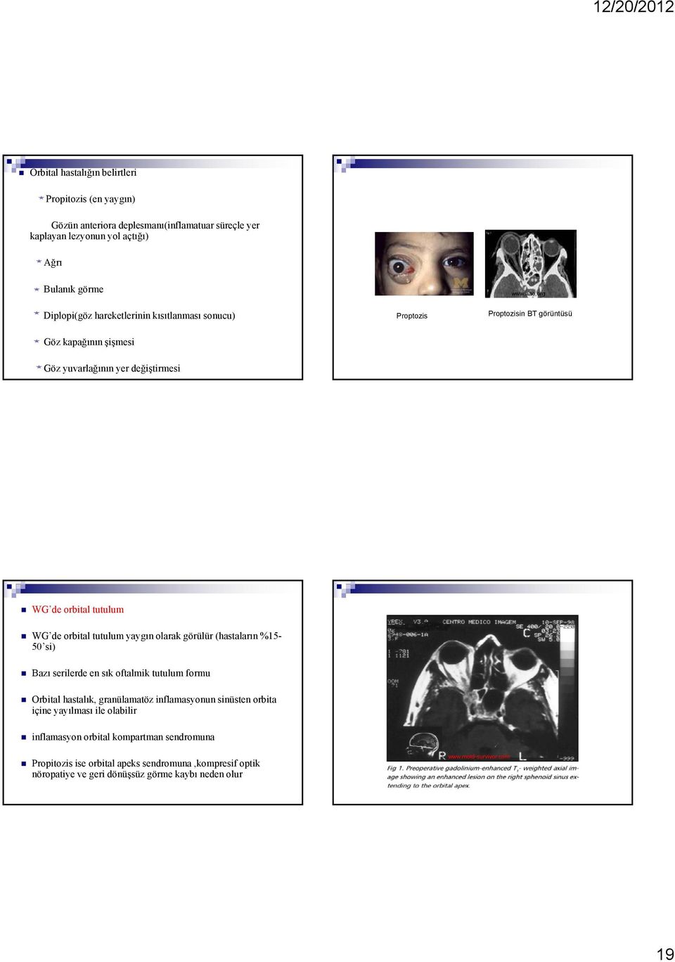 org Proptozisin BT görüntüsü Göz kapağının şişmesi Göz yuvarlağının yer değiştirmesi WG de orbital tutulum WG de orbital tutulum yaygın olarak görülür (hastaların %15-50 si)