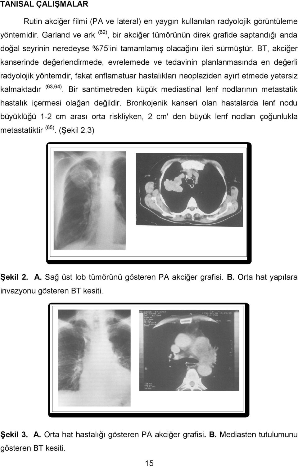 BT, akciğer kanserinde değerlendirmede, evrelemede ve tedavinin planlanmasında en değerli radyolojik yöntemdir, fakat enflamatuar hastalıkları neoplaziden ayırt etmede yetersiz kalmaktadır (63,64).