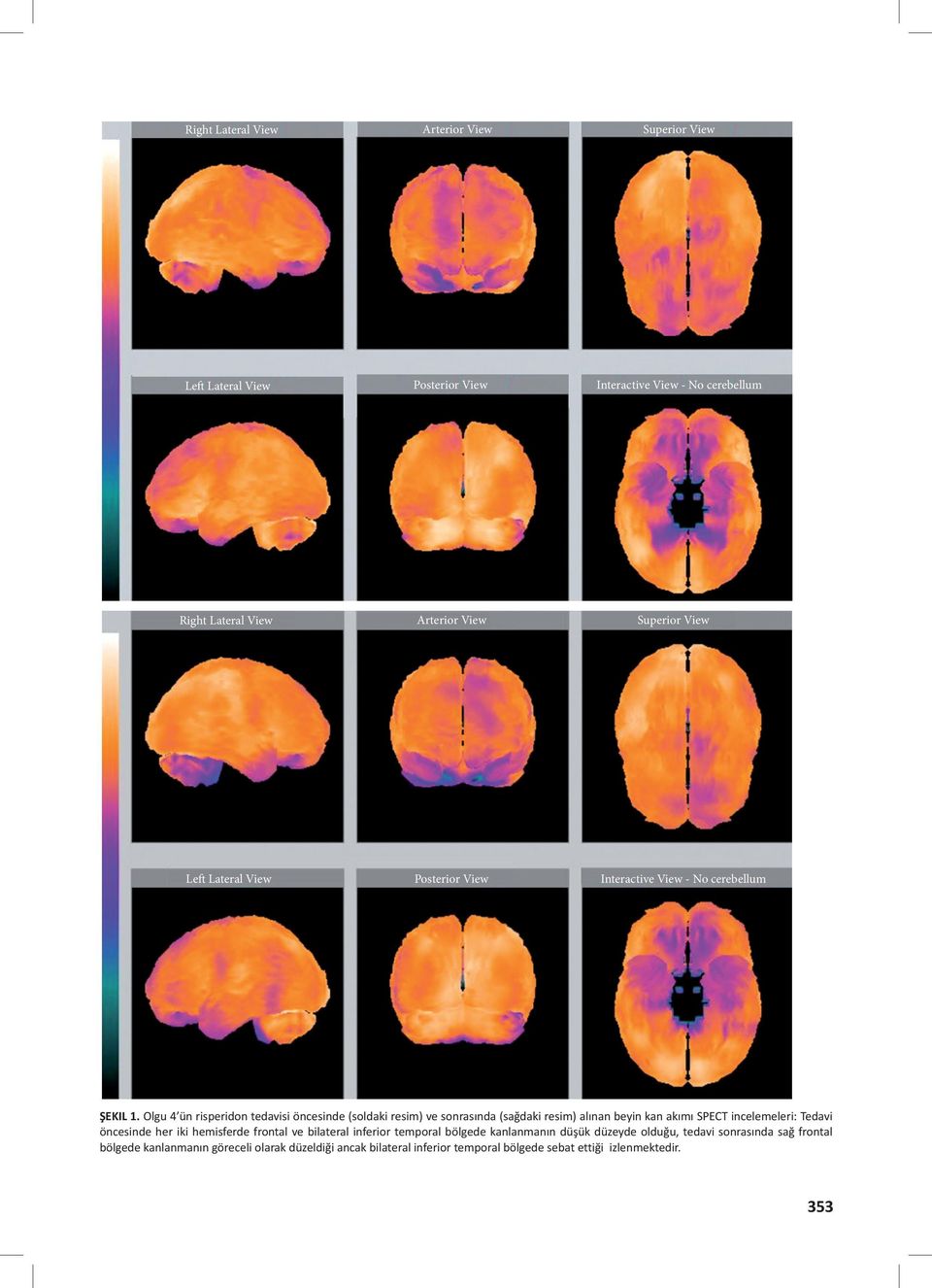 Olgu 4 ün risperidon tedavisi öncesinde (soldaki resim) ve sonrasında (sağdaki resim) alınan beyin kan akımı SPECT incelemeleri: Tedavi öncesinde her iki