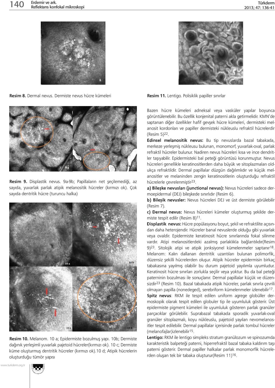 10 a; Epidermiste bozulmuş yapı. 10b; Dermiste dağınık yerleşimli yuvarlak pajetoid hücreler(kırmızı ok). 10 c; Dermiste küme oluşturmuş dentritik hücreler (kırmızı ok).