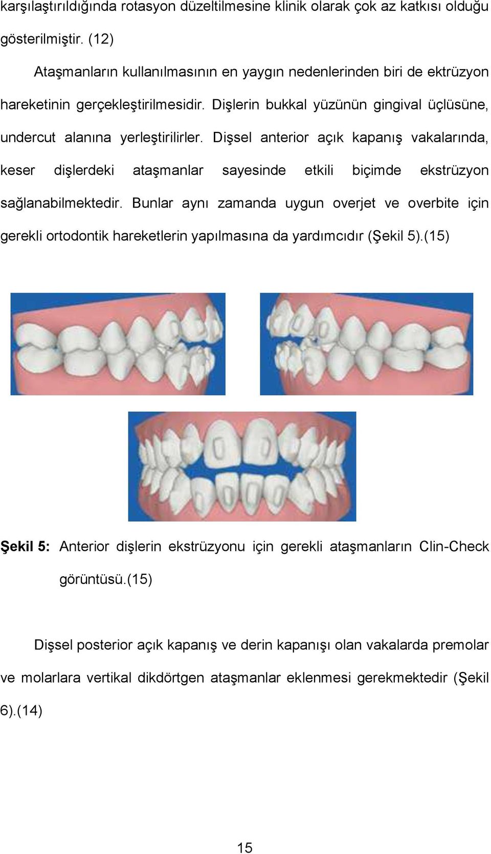 Dişsel anterior açık kapanış vakalarında, keser dişlerdeki ataşmanlar sayesinde etkili biçimde ekstrüzyon sağlanabilmektedir.
