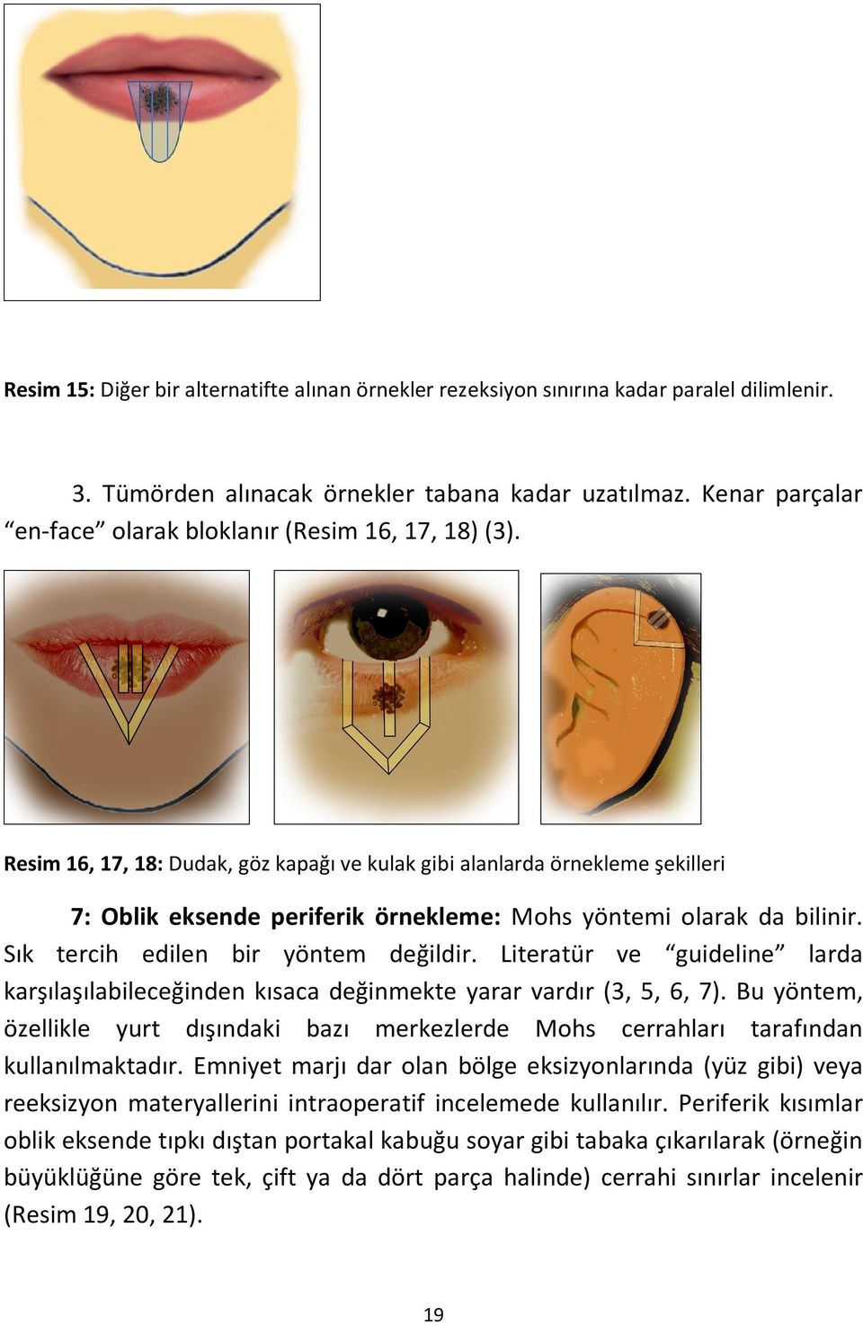 Resim 16, 17, 18: Dudak, göz kapağı ve kulak gibi alanlarda örnekleme şekilleri 7: Oblik eksende periferik örnekleme: Mohs yöntemi olarak da bilinir. Sık tercih edilen bir yöntem değildir.