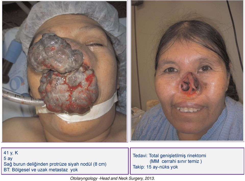 genişletilmiş rinektomi (MM cerrahi sınır temiz ) Takip: