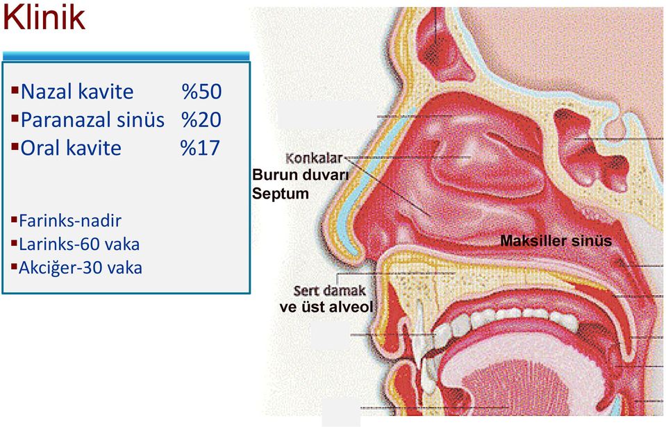 nadir Larinks 60 vaka Akciğer 30 vaka