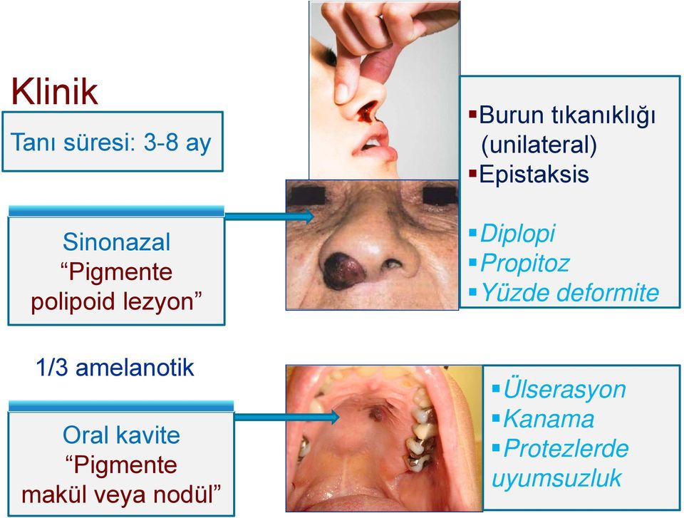 nodül Burun tıkanıklığı (unilateral) Epistaksis Diplopi