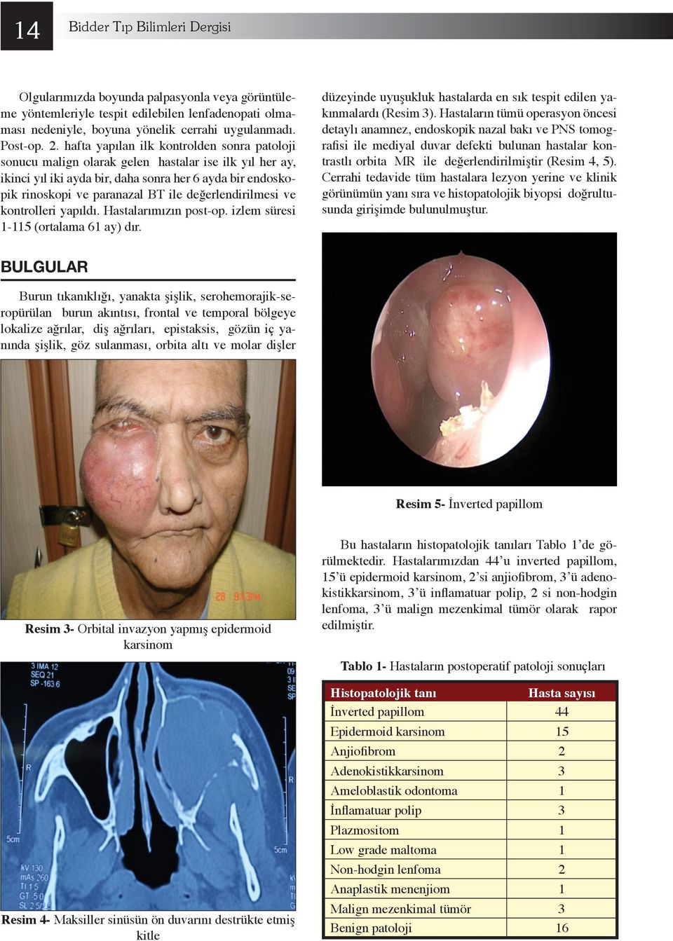 değerlendirilmesi ve kontrolleri yapıldı. Hastalarımızın post-op. izlem süresi -5 (ortalama 6 ay) dır. düzeyinde uyuşukluk hastalarda en sık tespit edilen yakınmalardı (Resim 3).