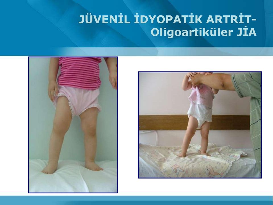 ARTRİT-